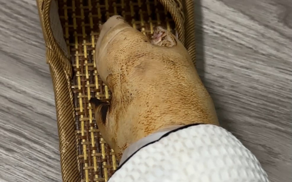 天气太冷了,脚都冻萎缩了