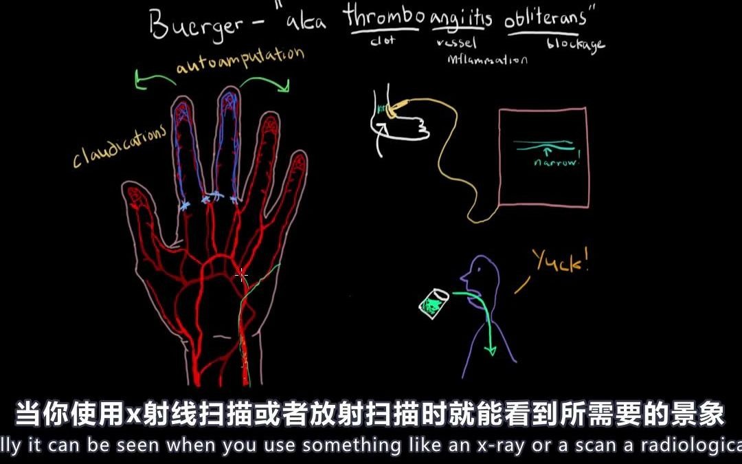 血管堵塞是什么病?血栓、血管炎、闭塞症哔哩哔哩bilibili