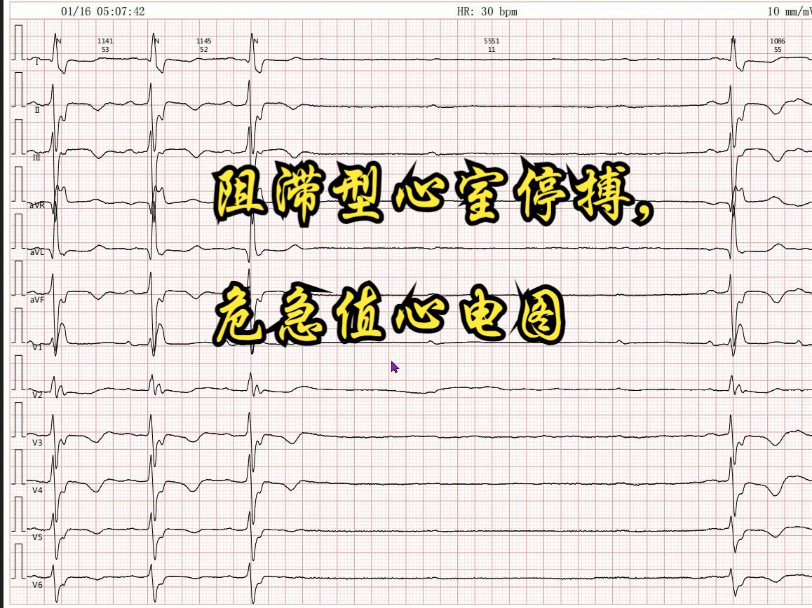 阻滞型心室停搏,危急值心电图哔哩哔哩bilibili