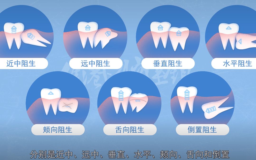 深圳拔智齿科普—阻生智齿有什么类型呢?危害是什么呢?哔哩哔哩bilibili