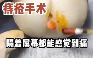 下载视频: 痔疮手术，看着就痛得不行