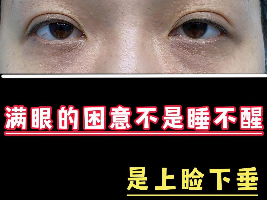 满眼的困意不是睡不醒,是上睑下垂哔哩哔哩bilibili