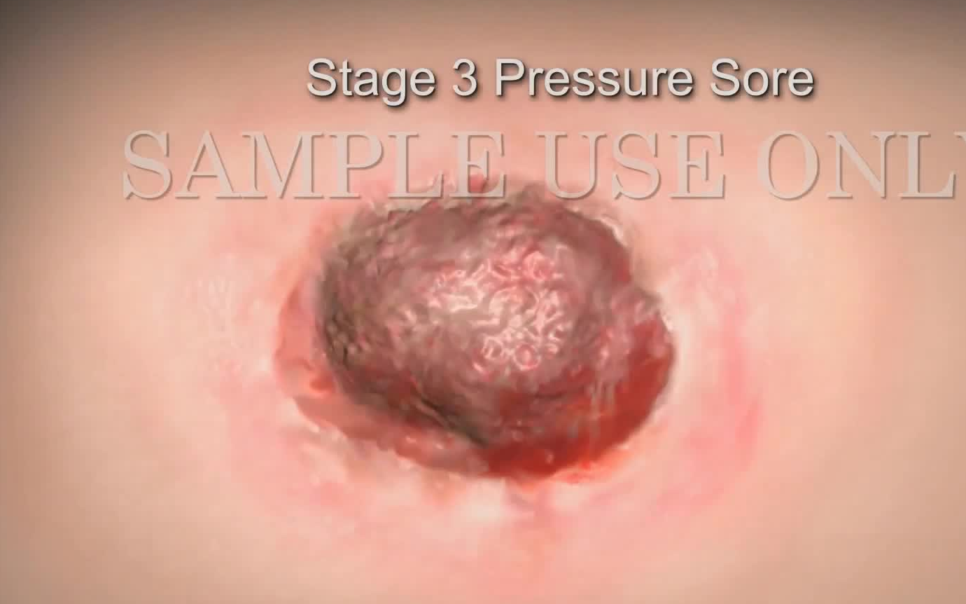 【3D医学动画】压疮的发生机制和分类(中英双字幕)哔哩哔哩bilibili