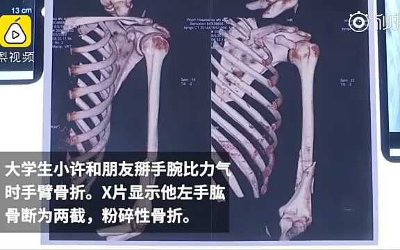 大学生掰手腕至手臂粉碎性骨折哔哩哔哩bilibili