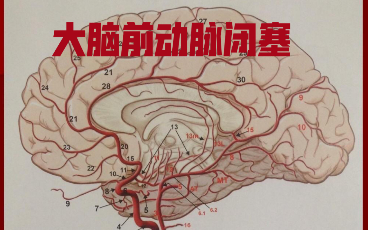 【脑血管疾病7】大脑前动脉闭塞型脑梗死哔哩哔哩bilibili