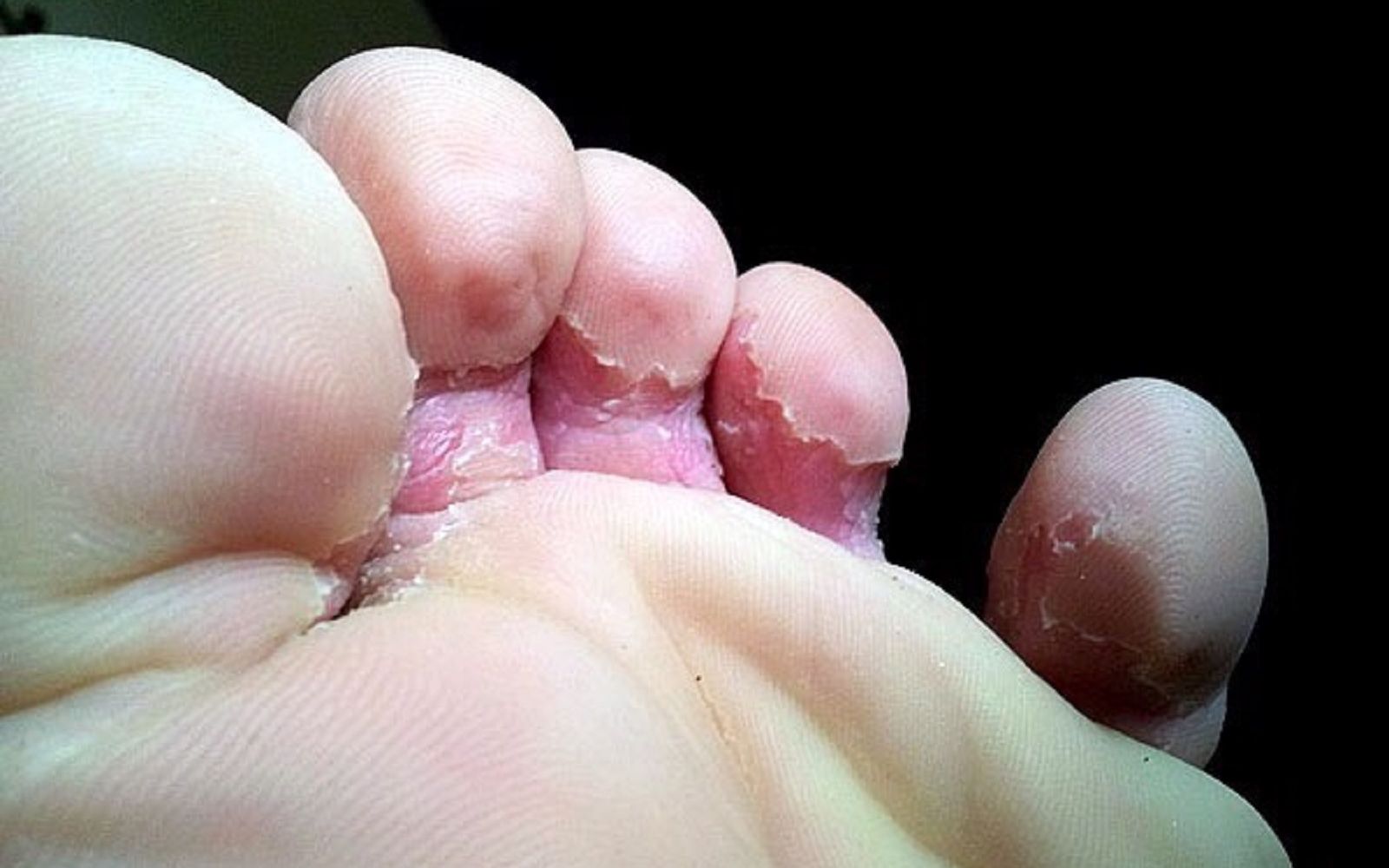 脚气脚臭脚趾缝瘙痒蜕皮?教你一个小方法,在家低成本短效除根!