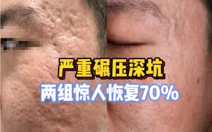 下载视频: 仅2次点阵激光，严重碾压深坑恢复70%！再也不用经历多次点阵“烂脸”的痛苦了！