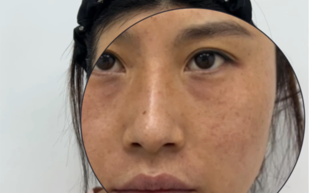 黑眼圈,泪沟,眼袋怎么解决?