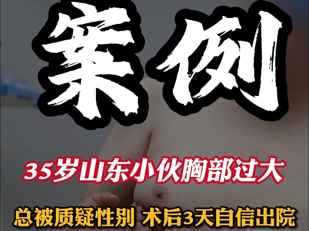 山东大汉胸部却白嫩丰满?总被同性过分关注,假期去缩胸解决困扰哔哩哔哩bilibili