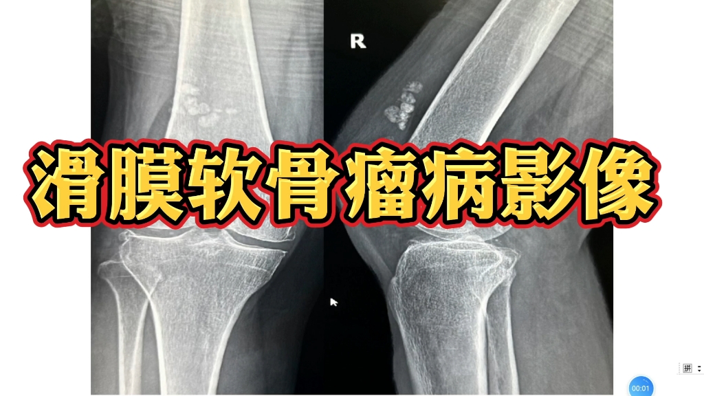 膝关节滑膜软骨瘤病典型影像表现分享,收藏学习!哔哩哔哩bilibili