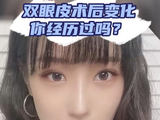 双眼皮术后变化,你经历过吗?哔哩哔哩bilibili