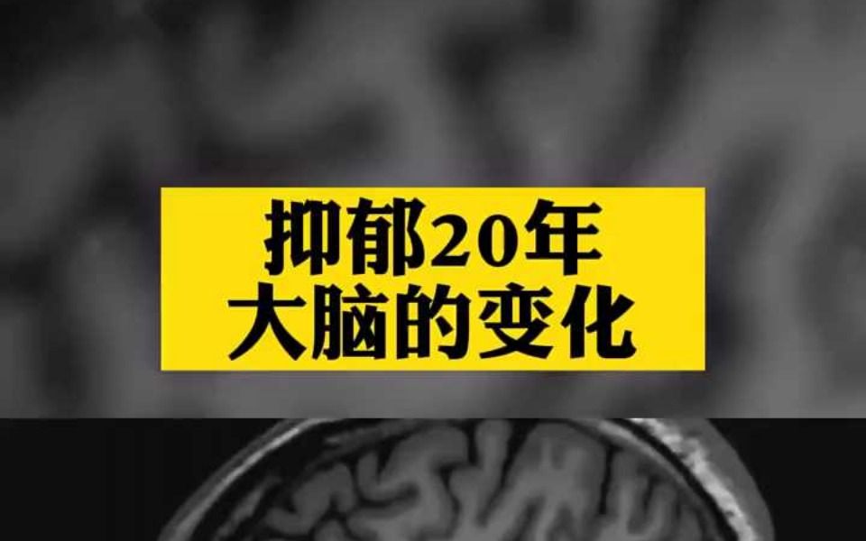 抑郁20年大脑的变化,贵阳郑主任:抑郁症不可怕,是能够治好的哔哩哔哩bilibili