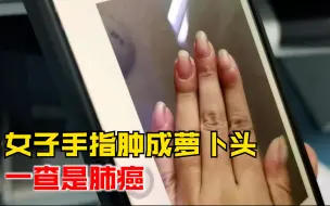 Tải video: 女子手指肿成“萝卜头”偶然被医生发现，一查竟是肺癌