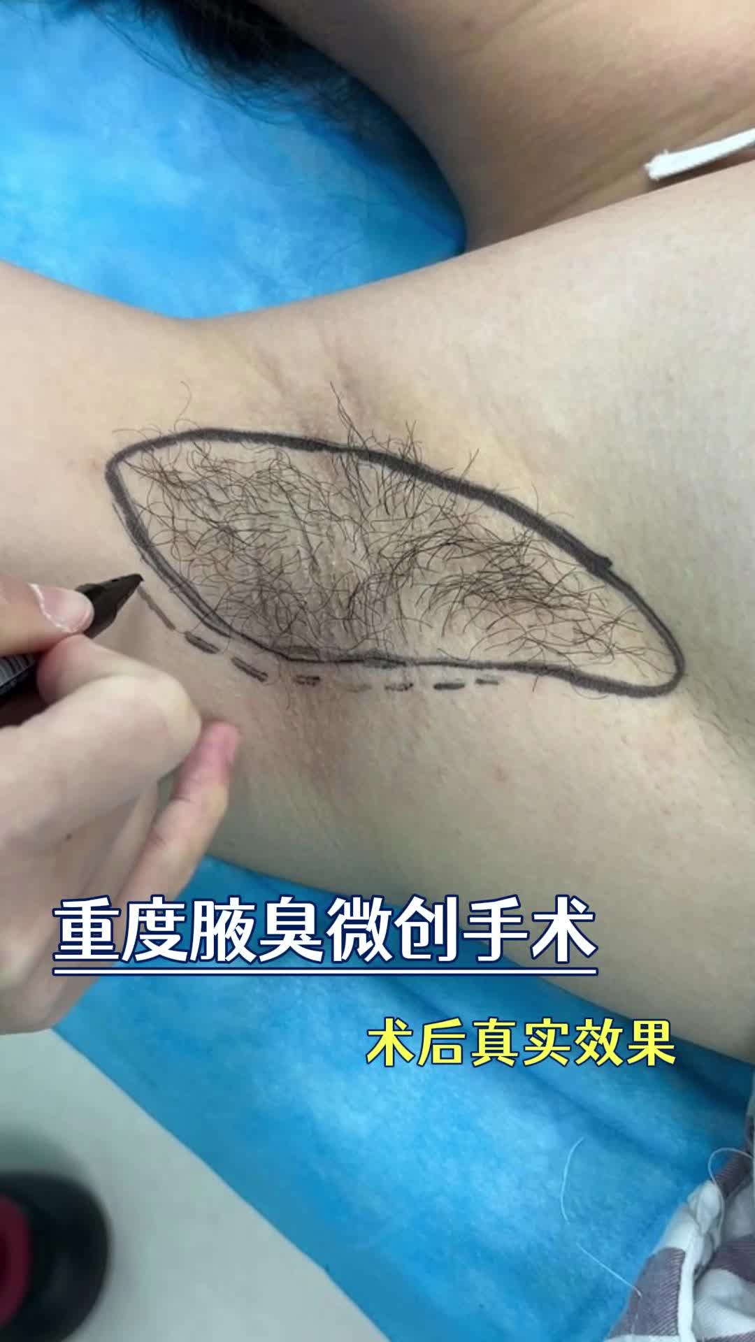 重度腋臭患者微创手术前后对比