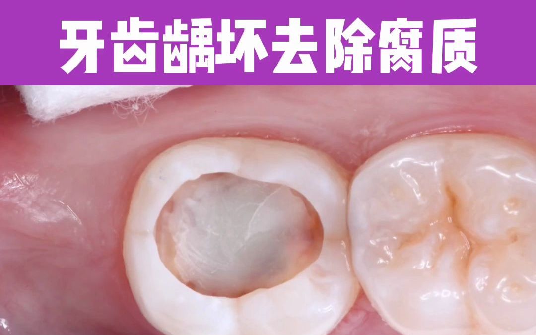 牙齿深度龋坏,补牙前要磨这么大个洞,看完表示我怕了_哔哩哔哩_bili