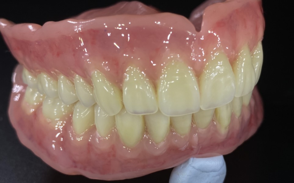 bps义齿,具有吸附力的义齿不等于吸盘,脱位时保持固位即可_哔哩哔哩