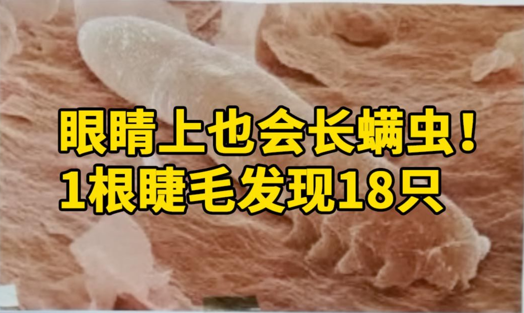 眼睛上也会长螨虫!1根睫毛发现18只螨虫:酒精泡2小时杀不死哔哩哔哩bilibili