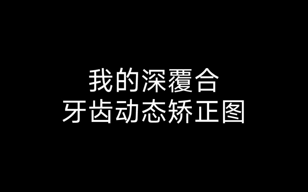 深复合牙齿动态矫正图.哔哩哔哩bilibili