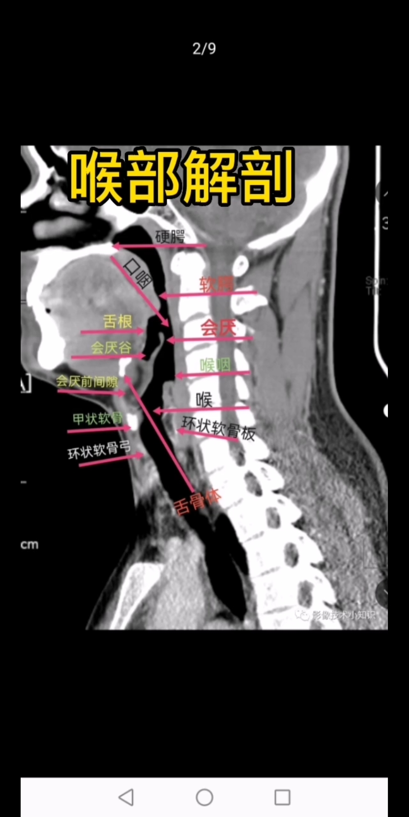咽喉部ct扫描范围图片图片