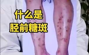 Descargar video: 糖尿病患者的小腿出现这种斑，叫胫前糖斑，要注意