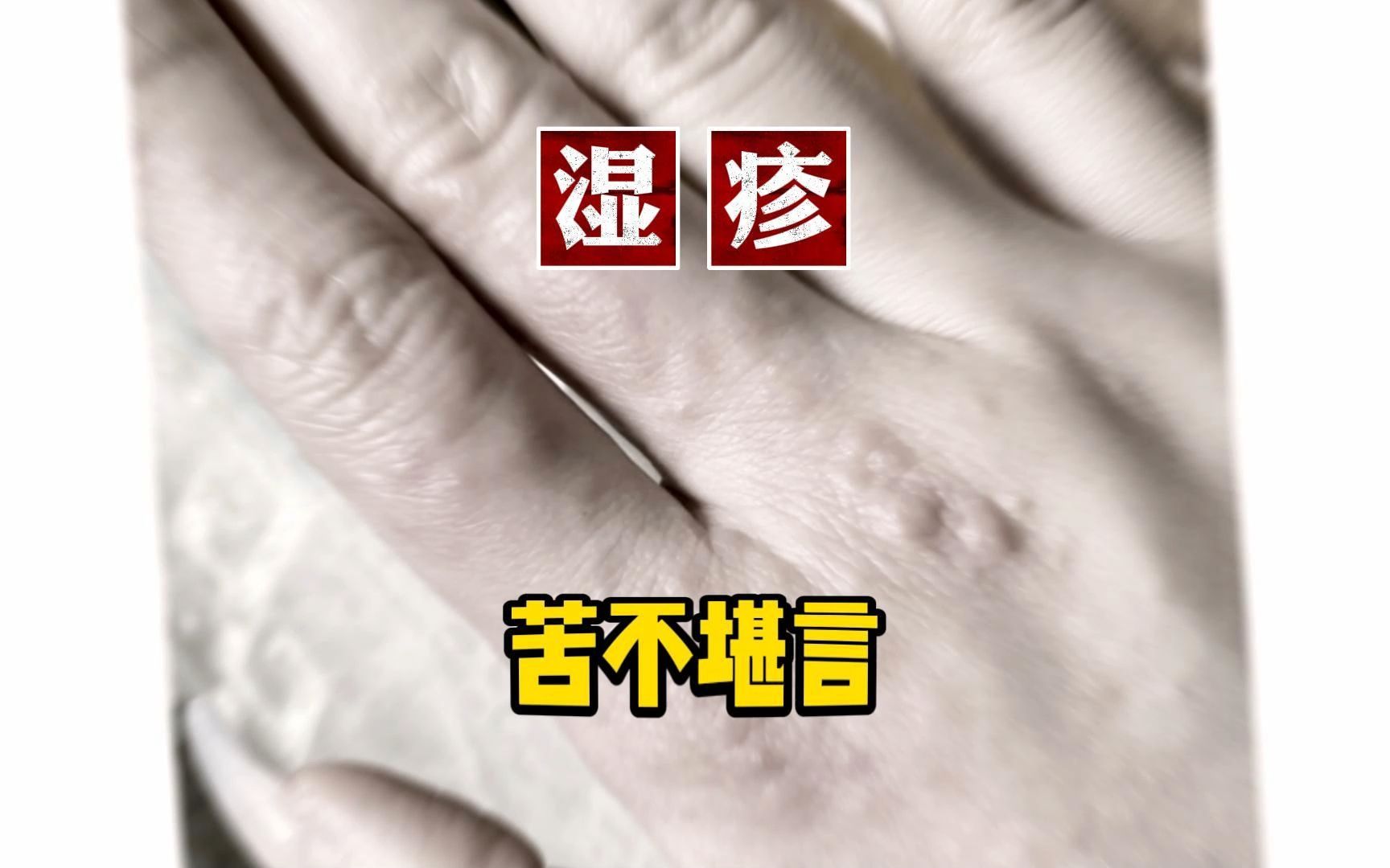 手上长密密麻麻的水泡,又疼又痒,这是接触性皮炎,别再碰洗涤剂了