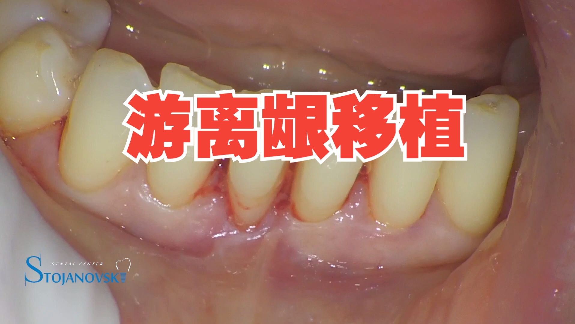 游离龈移植:free gingival graft