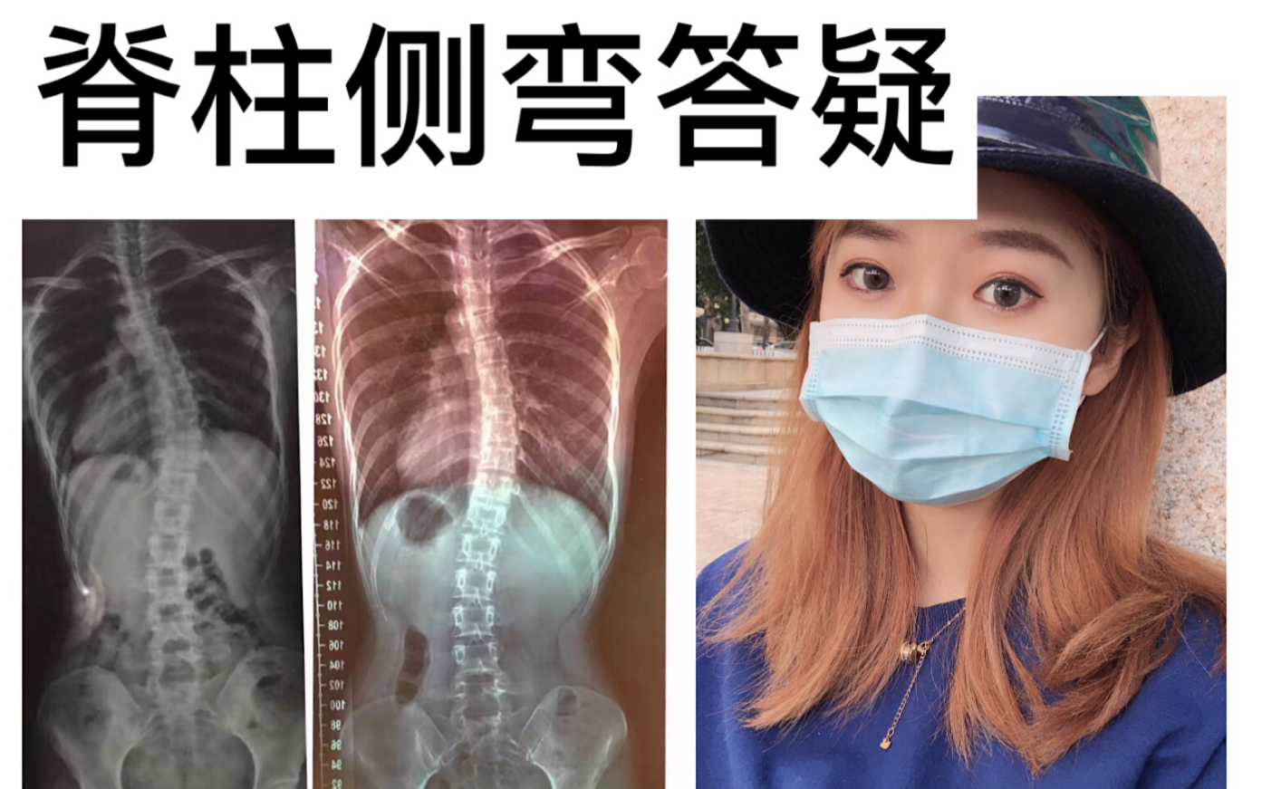 脊柱侧弯自我拯救度数减少七度答疑篇