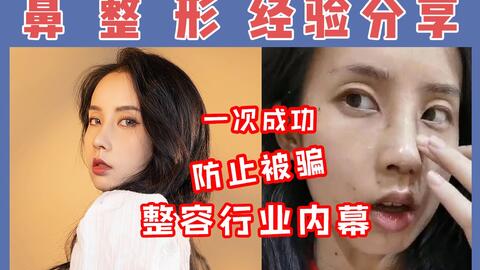 我做了韩国神颜高允真同款鼻子 术后痛到想去世的整容全过程记录 耳软骨隆鼻改善嘴凸 哔哩哔哩 Bilibili