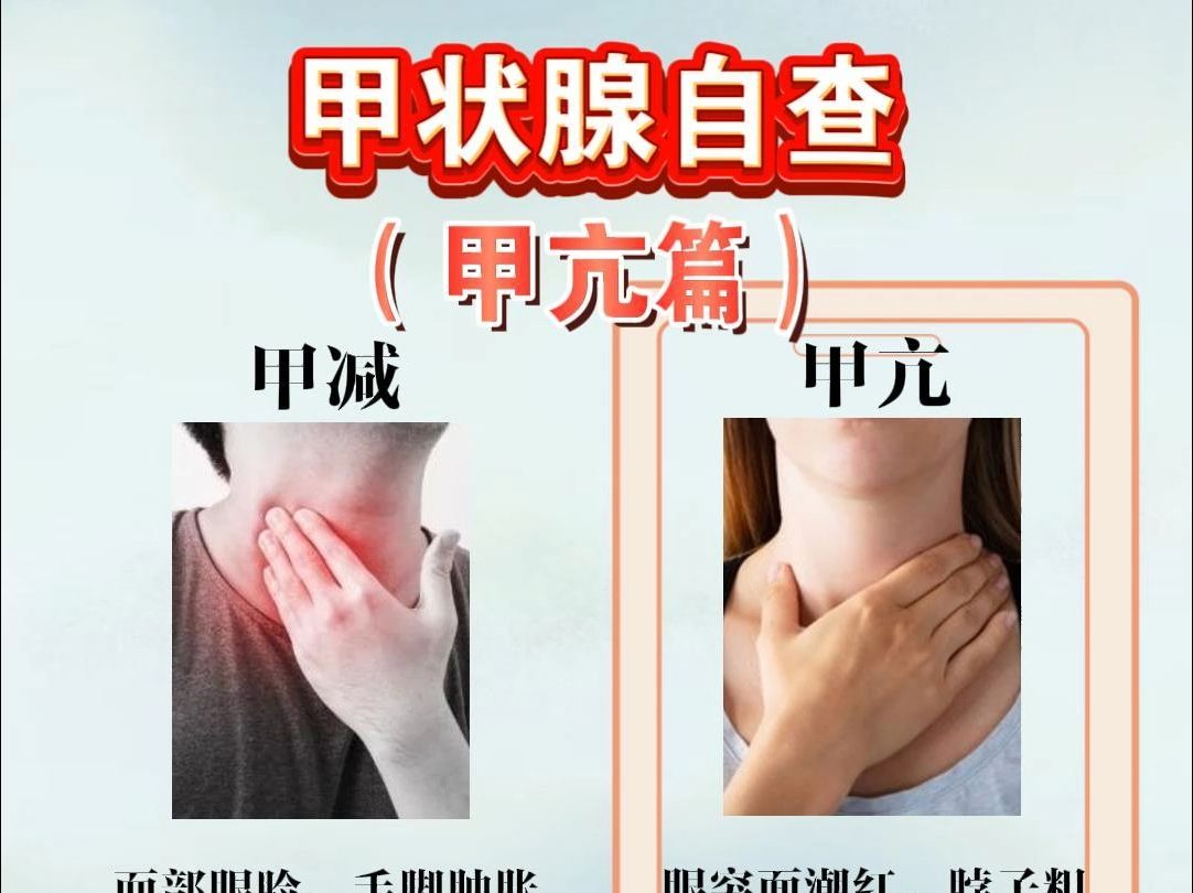 甲状腺自查(甲亢篇)哔哩哔哩bilibili