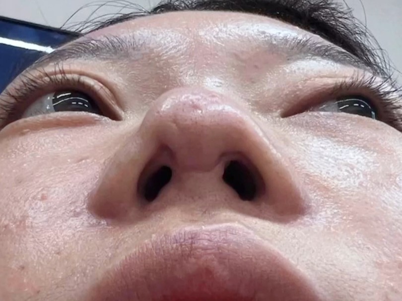 到底什么原因,鼻头挛缩如此严重!