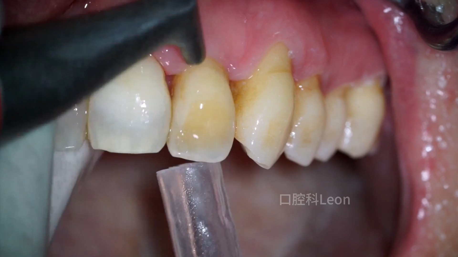 牙面喷砂有没有效果?看疗效吧