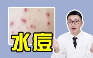 Download Video: 成人也会长水痘？水痘坑能祛除吗！水痘要怎么预防？