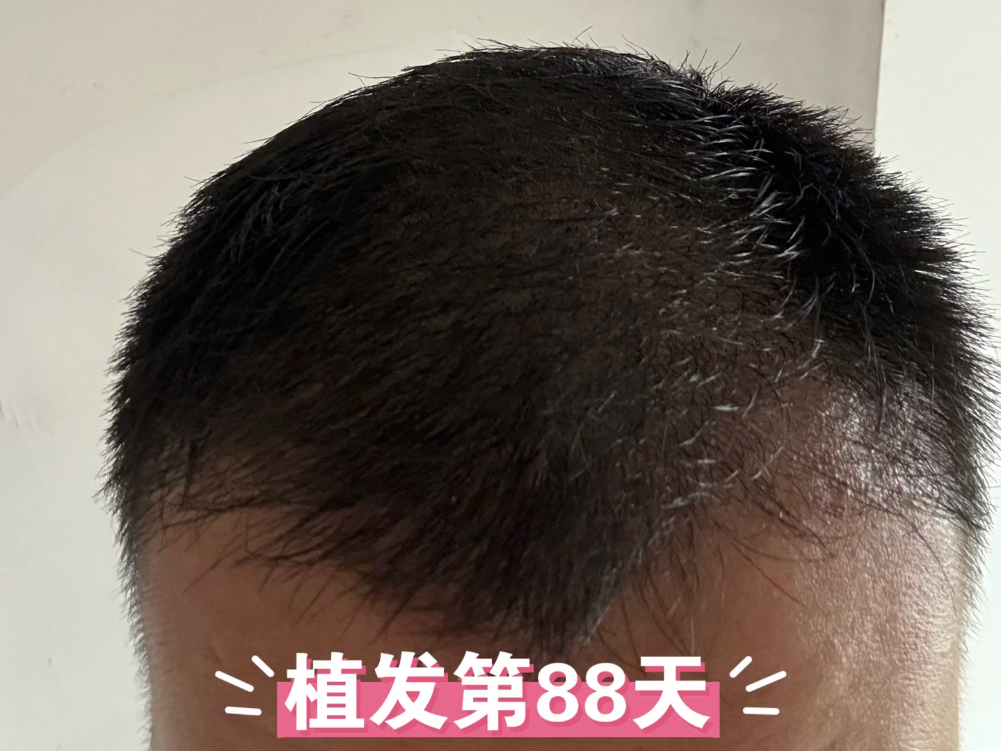 植发无需剃发(植发可以不用剃光吗)