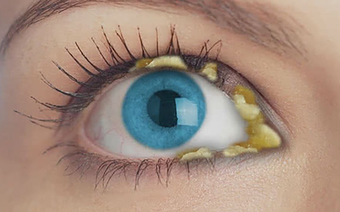 眼屎多是一种病吗?显微镜下放大1500倍,有这个现象的要注意了
