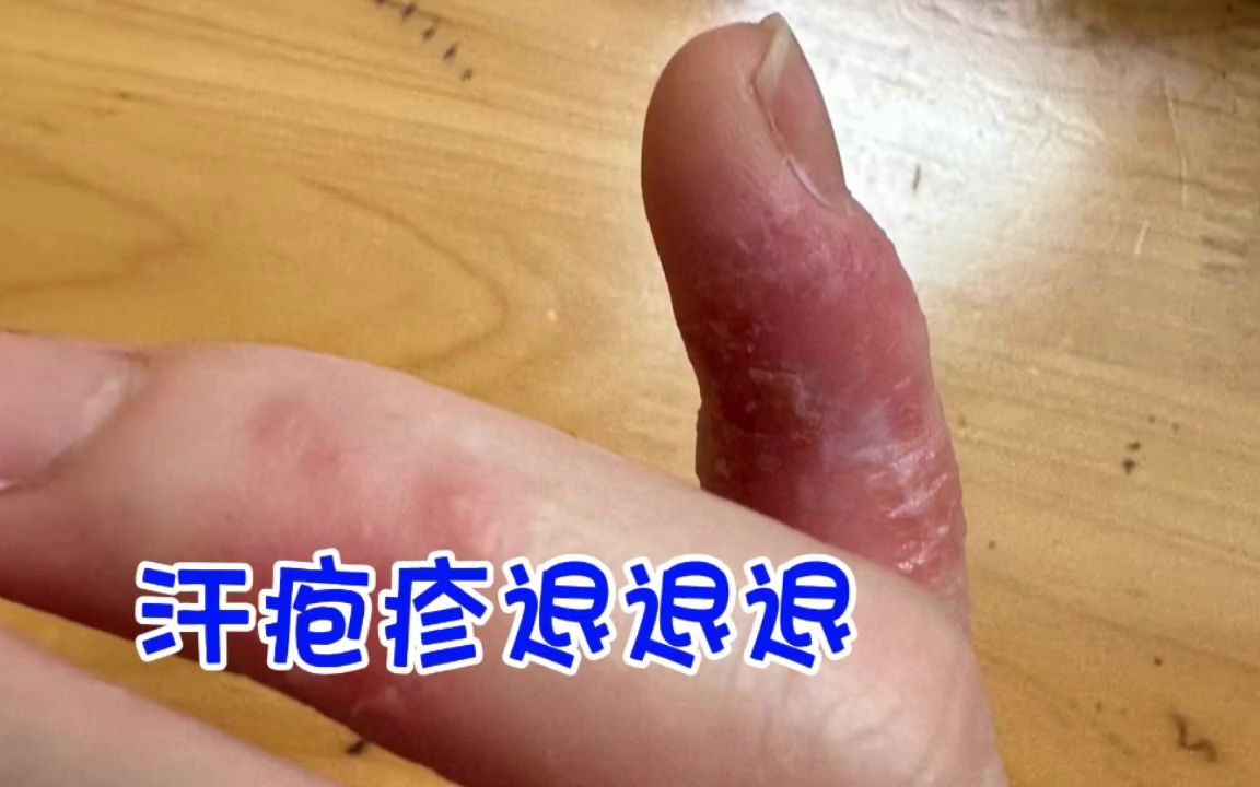 汗疱疹真的就这样没了,主打一个贼拉靠谱