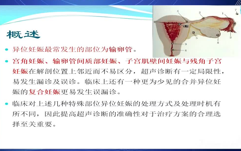 几种特殊类型异位妊娠的超声诊断.搬运自用哔哩哔哩bilibili