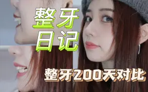 Descargar video: 整牙日记3｜正雅s8隐形牙套颌位重建｜戴牙套矫正下颌后缩200天对比