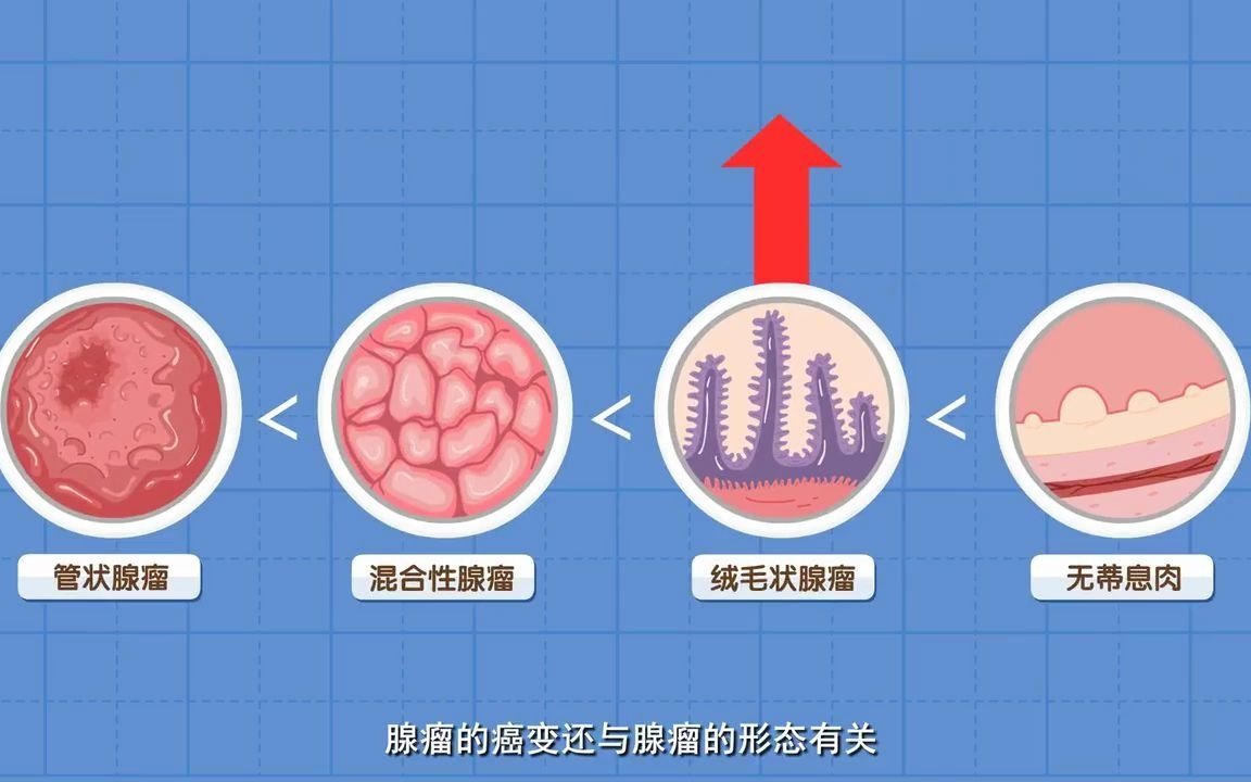 三分钟了解大肠癌!哔哩哔哩bilibili