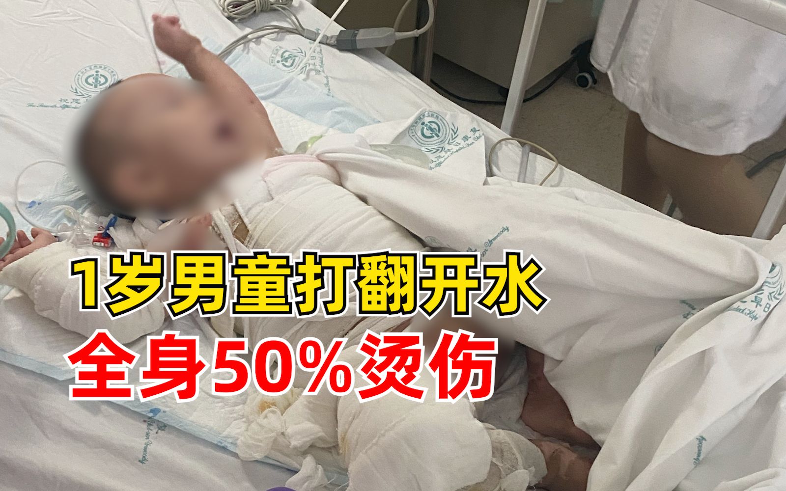 1岁男童打翻开水全身50%烫伤,大部分是重度二级烫伤和三级烫伤哔哩哔哩bilibili