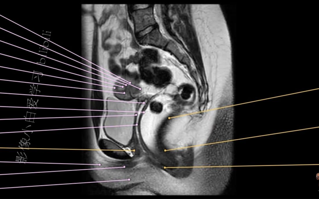 子宫核磁解剖图图片