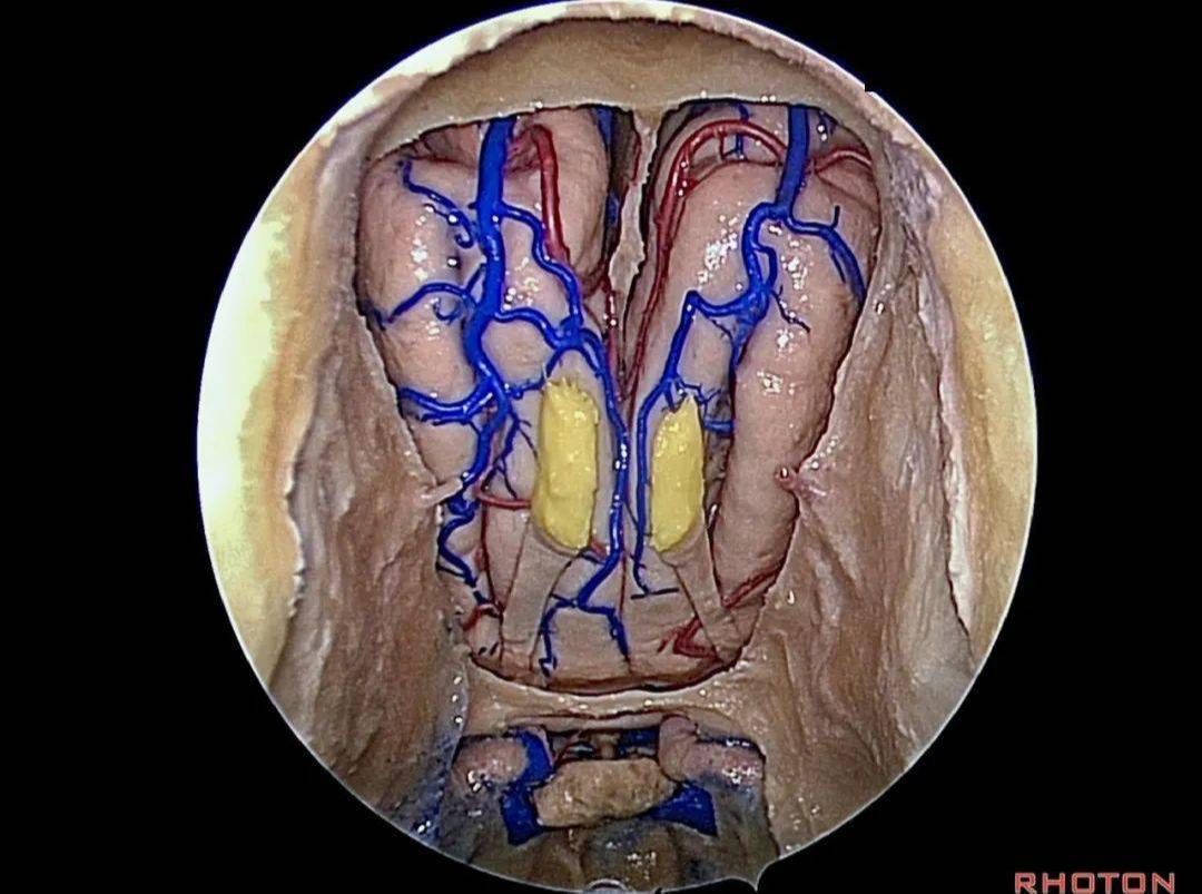 Rhoton系列解剖视频前颅底2哔哩哔哩bilibili