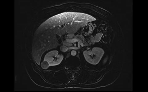 064 (肾乳头状癌)Papillary renal cell carcinoma哔哩哔哩bilibili