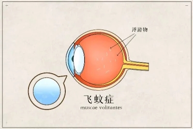 [图]音乐鉴赏107 飞蚊症 八卦象数疗法 400·030·720·600