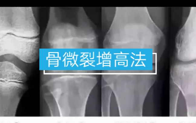 骨微裂增高法