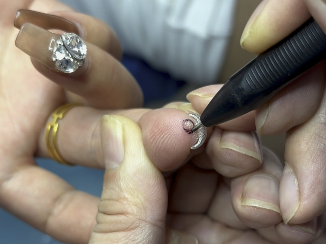 美女手指头的甲下疣