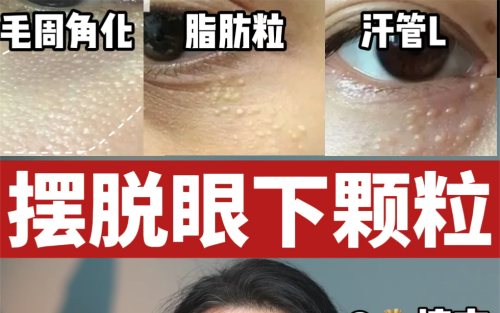 [图]8?摆脱眼下小颗粒❗️毛周角化/脂肪粒/汗管L❗️三步变光滑！手把手教你快速区分 精准解决⚠️彻底摆脱眼下小颗粒✅