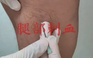 Download Video: 腿部刺血实操