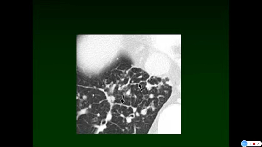 2021全国弥漫性肺病临床影像与病理诊断:09:肺部弥漫性网状影的影像诊断与鉴别哔哩哔哩bilibili