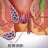 肛周脓肿的形成