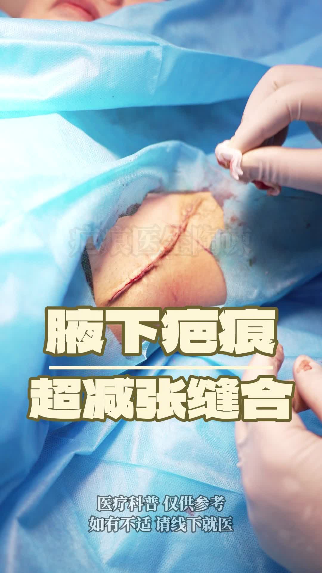 传统腋臭手术留下疤痕,手术切除中